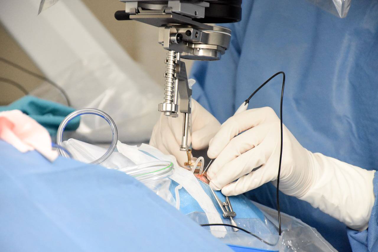 Cirugía de Retina Mínimamente Invasiva y Catarata Avanzada